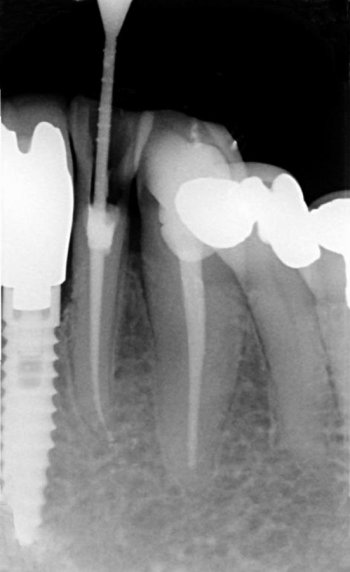 root - canal